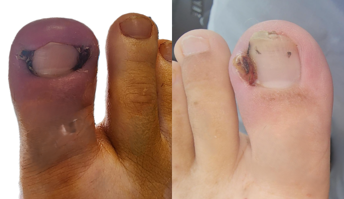 What is an Ingrown Toenail?