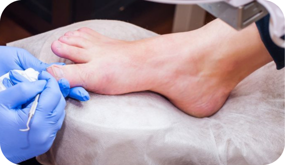 What Causes Ingrown Toenails?