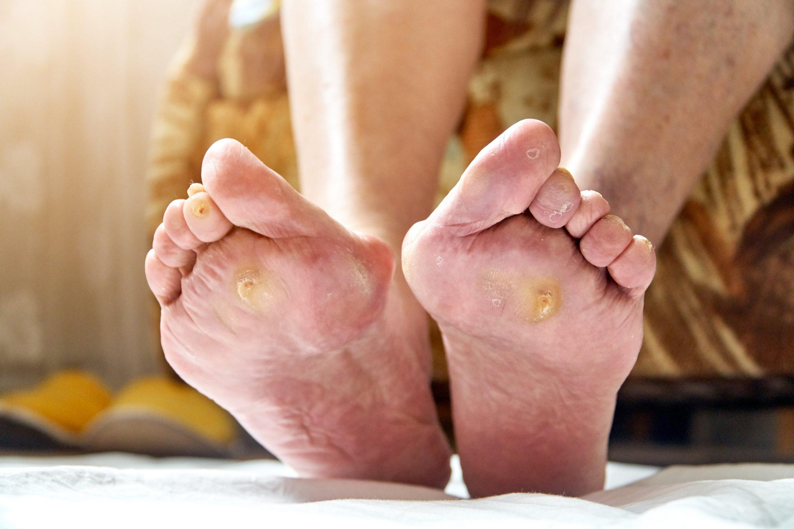 How Does Diabetes Affect Your Feet?