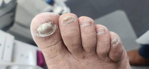 What are Thickened toenails?