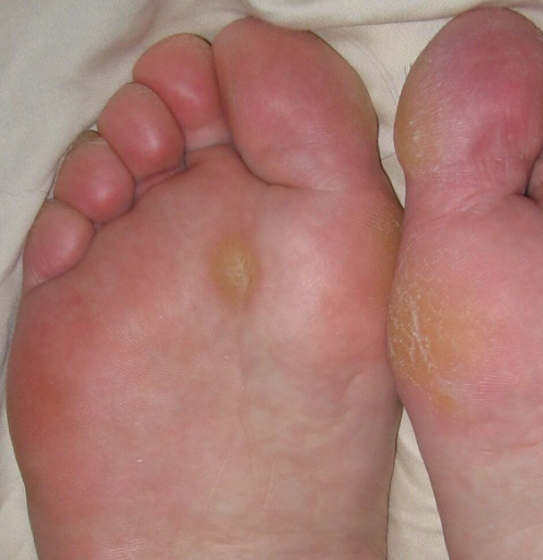 What is a Callus?