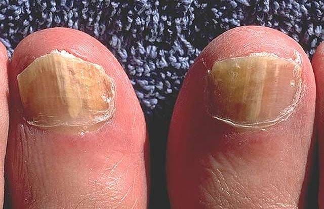 What are Fungal Toenails?