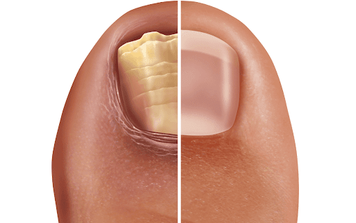 Treatment Options and Prevention Tips for Fungal Toenails