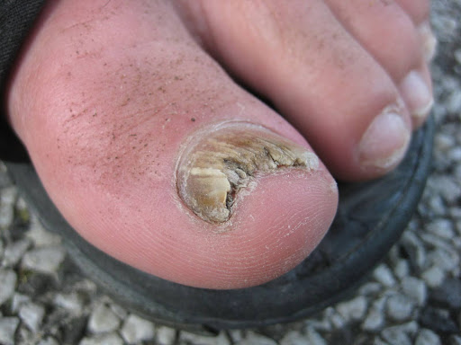 What are the typical causes of Fungal Toenails?