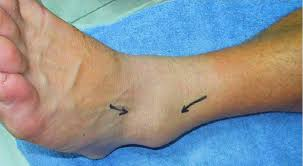 Symptoms of an Ankle Sprain or Injury