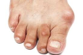 What are Bunions, Hammertoes & Toe Joint Pain?
