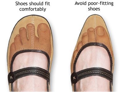 Treatment Options and Prevention Tips for Bunions, Hammertoes & Toe Joint Pain