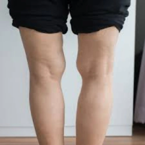 What are Lower Limb Alignment Changes in Children?