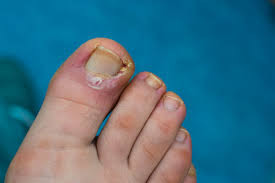 What is an Ingrown Toenail in Children?