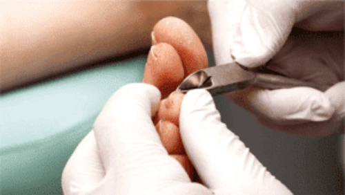 Treatment Options and Prevention Tips for Ingrown Toenails