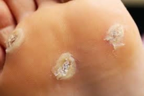 What are Warts & Verrucae in Children?