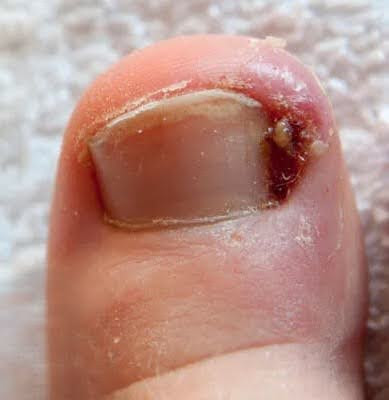 Symptoms of Ingrown Toenails in Children