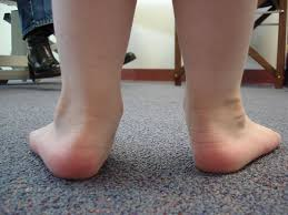 What are Flat Feet in Children?