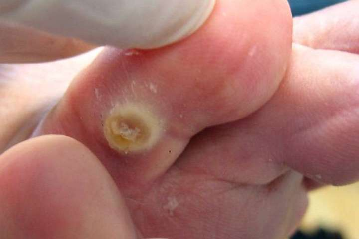 Symptoms of Warts & Verrucae in Children