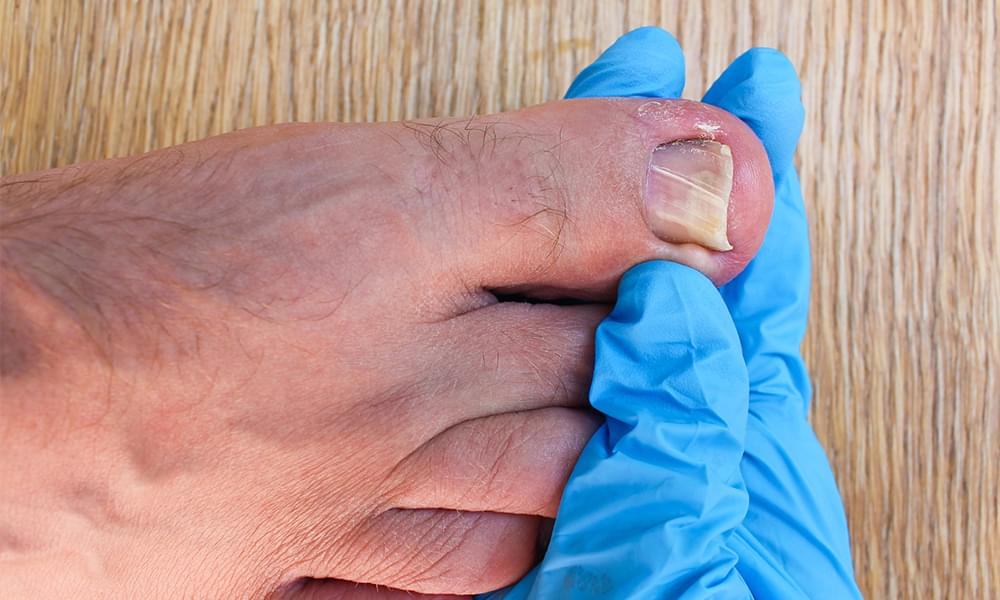 Ingrown Toenail Surgery