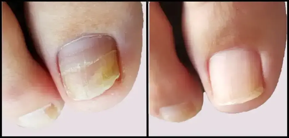 Fungal nail infections