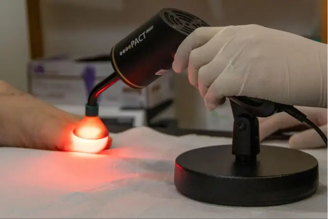 Say Goodbye to Fungal Nail Infections