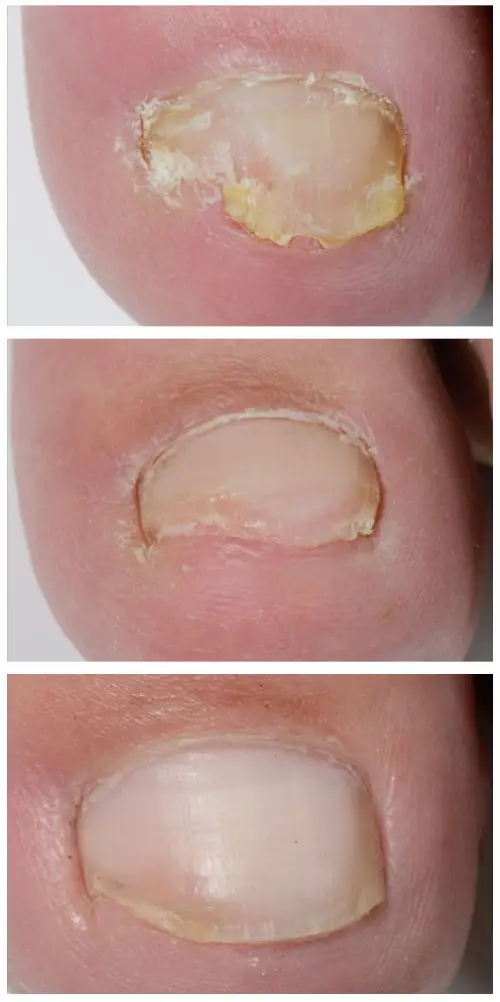 Prevent Reinfection After PACT® Therapy
